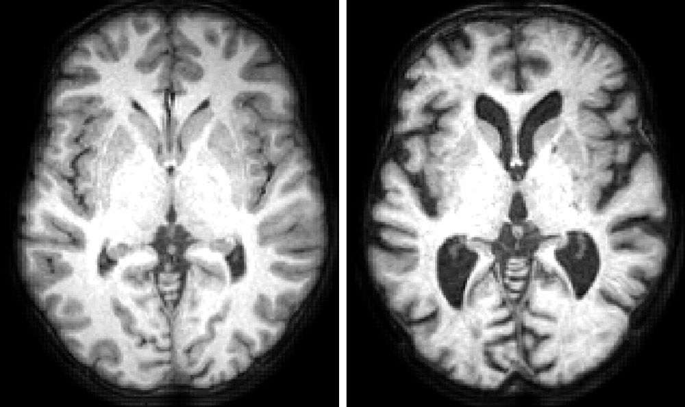 图1所示。结构的MRI images showing a horizontal section through a typical healthy 19-year old and the brain of a typical healthy 86-year old.