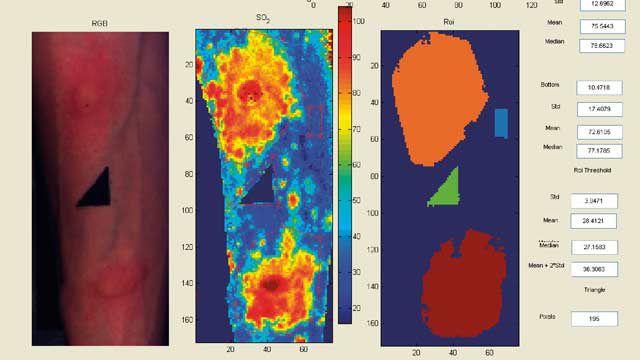 来自诺丁汉大学的高光谱图像，通过在组织表面照射光线，精确测量氧气水平，生成氧饱和度图，以方便临床研究人员和医生的工作。