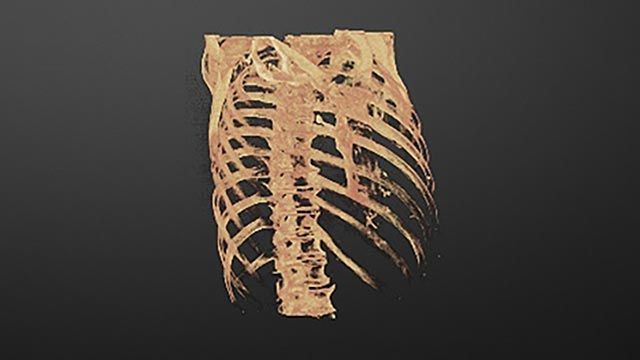 人体胸部的CT扫描。