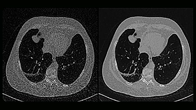 人类胸部低剂量原始CT扫描，旁边是同一图像的去噪版本。