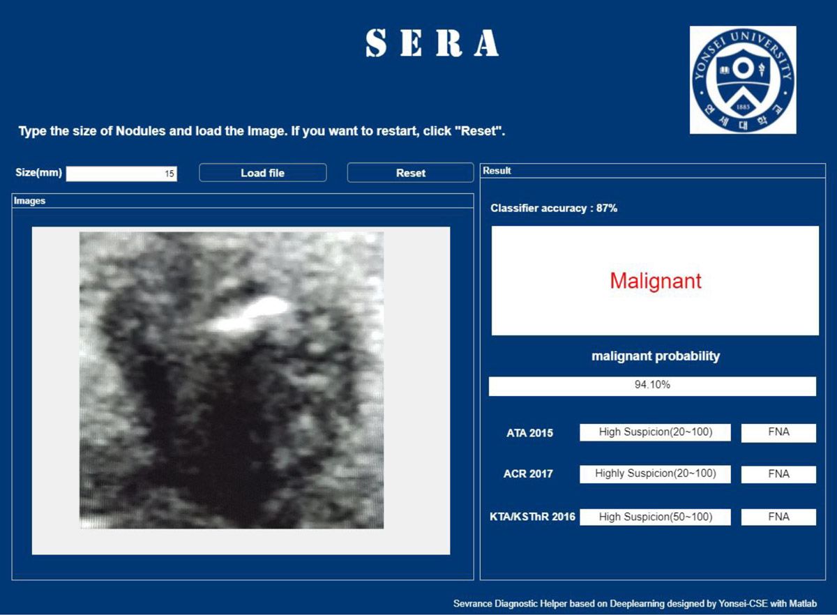 SERA网页应用的截图，显示了结节图像的结果，并将其分类为恶性，概率为94.10%。分类器准确率为87%。