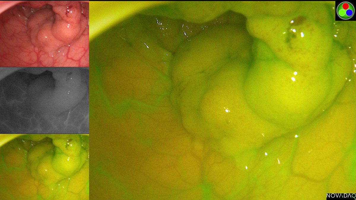 通过内窥镜显示同一直肠肿瘤的四幅图像