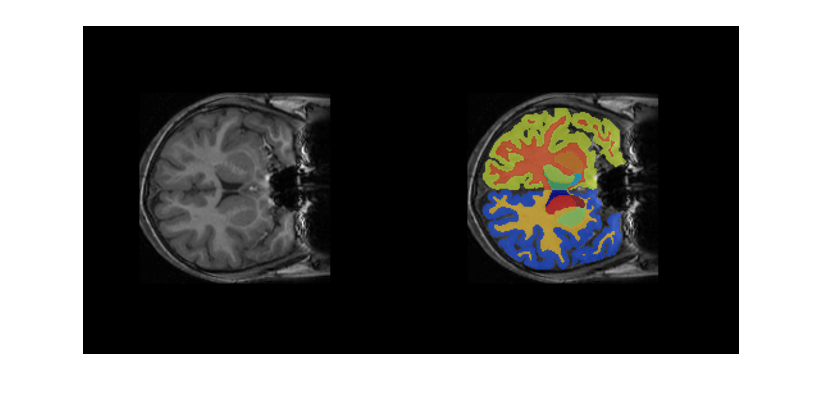 用预训练的三维U-Net网络分割脑MRI