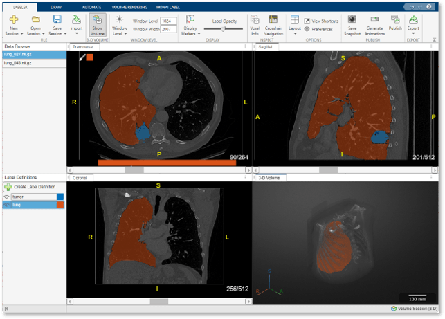 医学图像标签应用程序的快照，显示CT胸部容积与肺和肿瘤的3-D标签