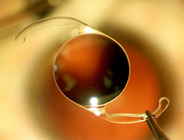 人工晶状体被镊子夹在眼睛上的特写。