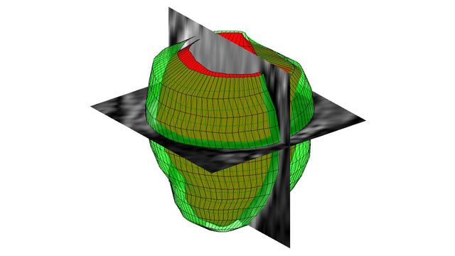 人左心室磁共振图像的三维几何重建。