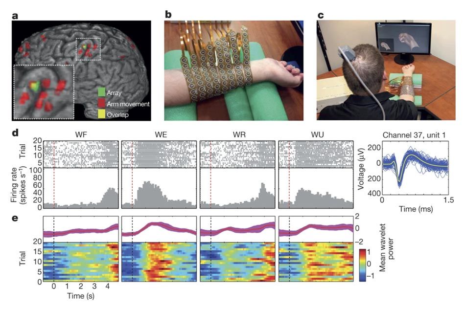 这张照片来自2016年的NeuroLife研究。左上角是大脑的图像，显示了植入微网格阵列的位置。中上显示的是Burkhart的前臂被电极套筒包裹着。右上显示伯克哈特正面对着电脑显示器。显示器上是他右手的化身。他戴着电极套。图的底部显示了一系列灰度直方图和多色光栅读数，这些读数与手腕运动时的神经元活动相对应。