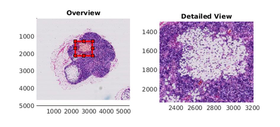 在MATLAB中用<code>bigimageshow</code>显示含肿瘤组织的淋巴结图像。