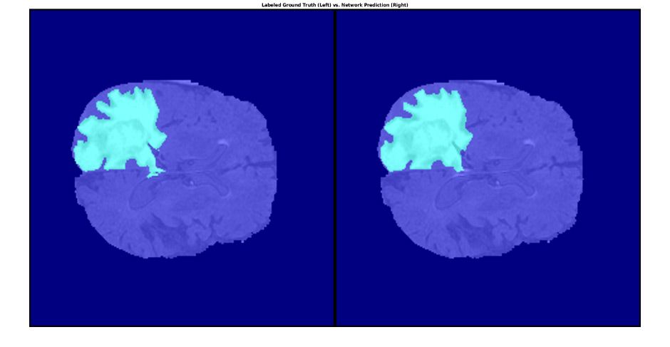用MATLAB绘制的脑组织分段肿瘤，图左为标记的地面真值(ground truth)，图右为网络预测(network prediction)。