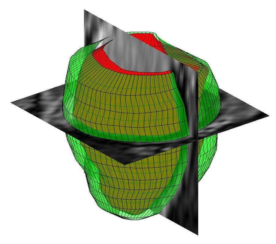 用MATLAB从MR图像重建人左心室三维几何。