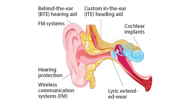 Sonova通过基于模型的设计缩短助听器和植入物的产品开发时间